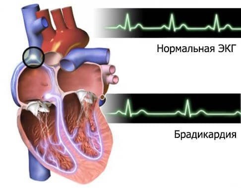 Частота сердечных сокращений при брадикардии